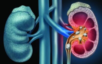 Kidney Stones: Treatment & Prevention